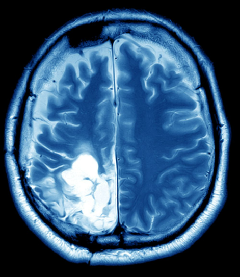 brain tumor IMEs