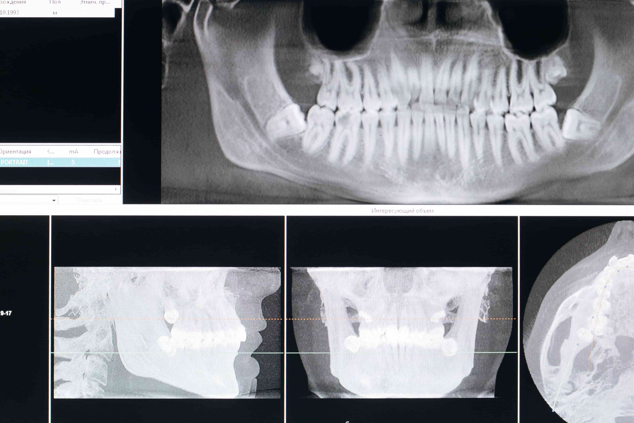 IMEs in Motor Vehicle Accident Dental Injury Cases